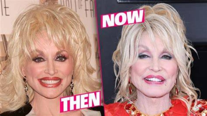 Does Dolly Parton Wear Dentures | False Teeth Before And After